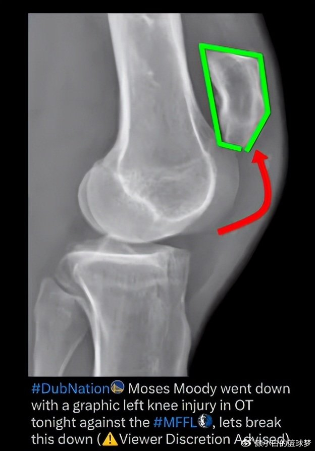 勇士球员摩西-穆迪左膝髌腱撕裂 将缺席25-26赛季