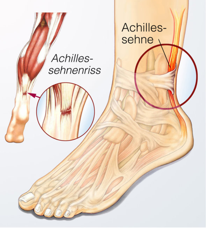 勇士球员摩西-穆迪左膝髌腱撕裂 将缺席25-26赛季